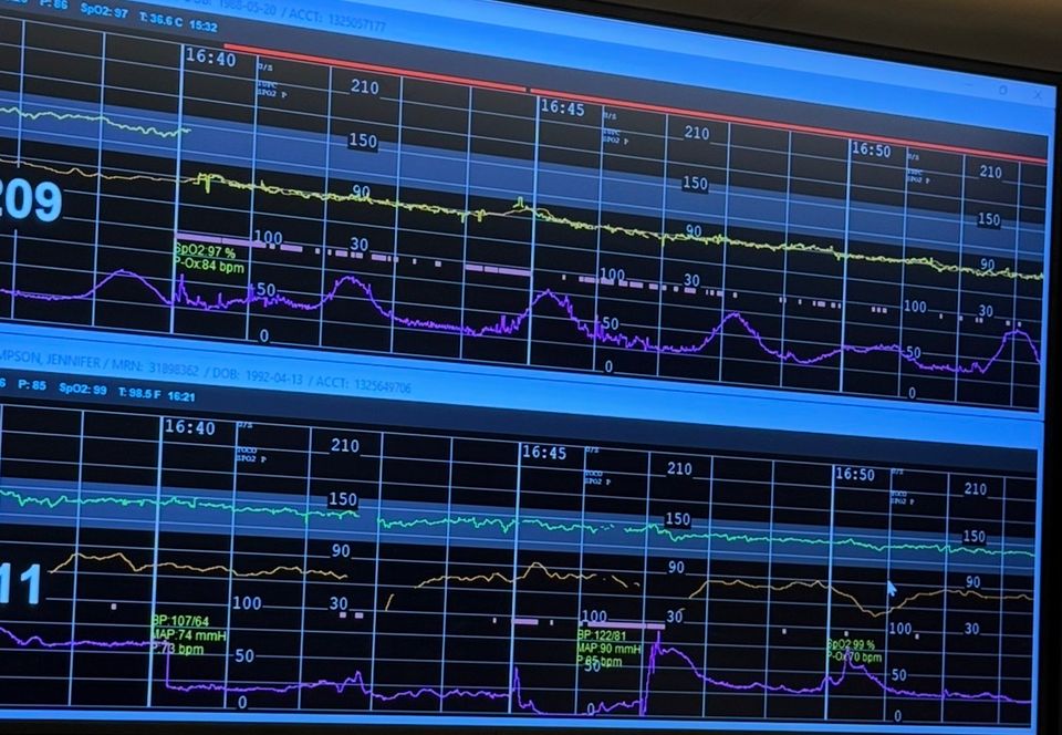 Fetal monitoring interference showing signal loss during epidural