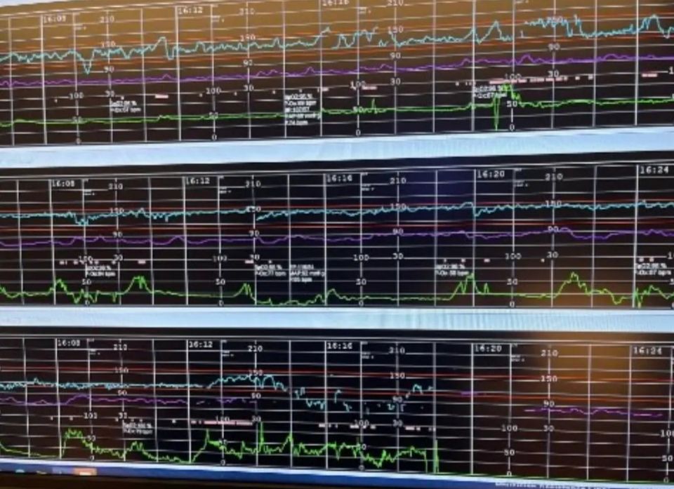 Fetal monitoring chart showing early labor contractions